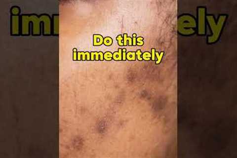 2 steps to reduce acne scars