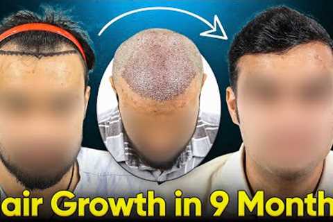 Hair Growth Results (9 Months Before and After) | Hair Transplant Time Lapse and Cost Details #hair