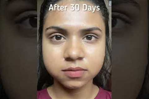 My skincare routine and acne  transformation in just 30 days #skincare #shorts #acnetreatment #acne