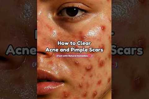 How to Clear Acne &amp; Pimple marks #shorts #888 #beauty #fyp #acne #kpop #skincare #youtubeshorts