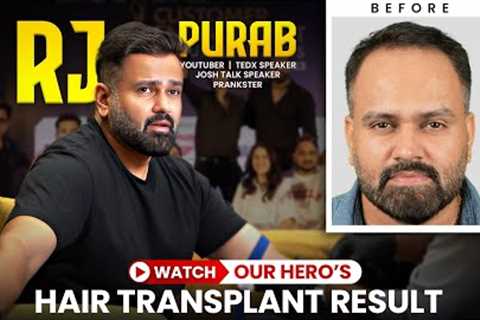 RJ Purab Hair Transplant Results | Amazing Hair Transformation in Hairfree &amp; Hairgrow Clinic