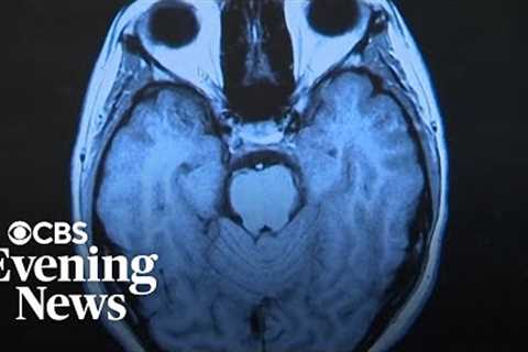 Researcher says Long COVID causing great deal of suffering