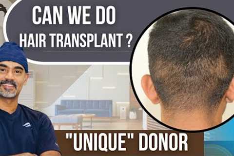 Hair Transplant In Chennai | Best Results Surgeon Cost &amp; Center Of Hair Transplant Of Chennai