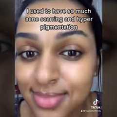 How I got rid of my acne scars and hyper pigmentation!!