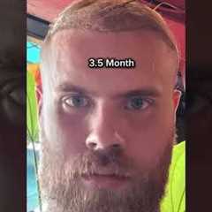 Transformation in the First 4 Months After Hair Transplant
