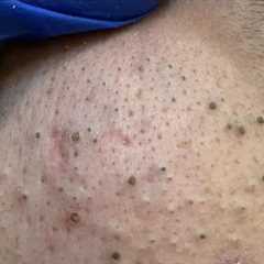 Pore Cleaning Bliss ASMR - Acne & Blackhead Removal with Facial Care Routine