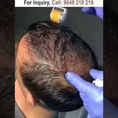 Dermaroller for hair growth #dermaroller #dermarollerforhairgrowth #hairgrowth #dermarollerforhair