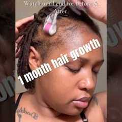 1 month Hair growth journey! #minoxidil #hairgrowth #hairgrowthchallange #baldinghair #hairloss
