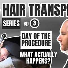Watch My Hair Transplant Procedure in Istanbul: Day of Surgery, What to Expect