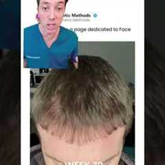 Hair Transplant Recovery Timeline