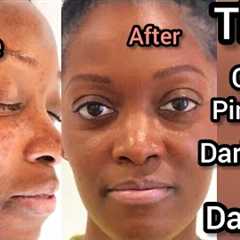 Clear pimples and darkspots With My morning and night simple skincare routine !