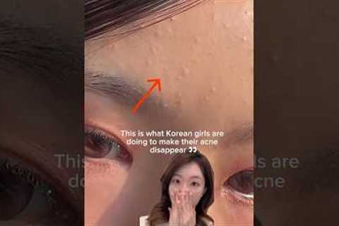 How Korean girls remove acne/tiny pimples/whiteheads #shorts