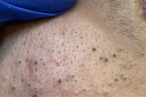 Aggressive Blackhead Extraction ASMR — Pimple Popping &amp; Facial Care
