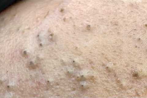 Intense Pore Cleaning Techniques - Acne &amp; Blackhead Removal ASMR Experience