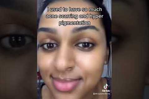 How I got rid of my acne scars and hyper pigmentation!!