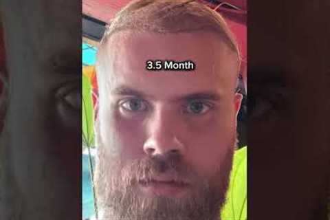 Transformation in the First 4 Months After Hair Transplant