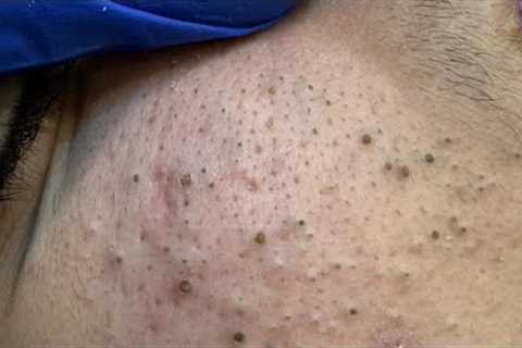 Pore Cleaning Bliss ASMR - Acne & Blackhead Removal with Facial Care Routine