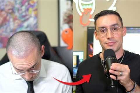 Turkey Hair Transplant: 1-Year Results | Before & After