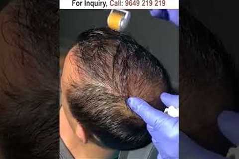 Dermaroller for hair growth #dermaroller #dermarollerforhairgrowth #hairgrowth #dermarollerforhair