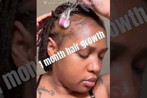 1 month Hair growth journey! #minoxidil #hairgrowth #hairgrowthchallange #baldinghair #hairloss