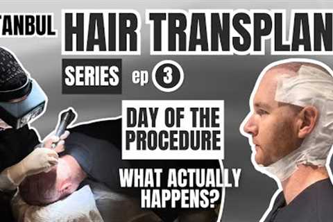 Watch My Hair Transplant Procedure in Istanbul: Day of Surgery, What to Expect