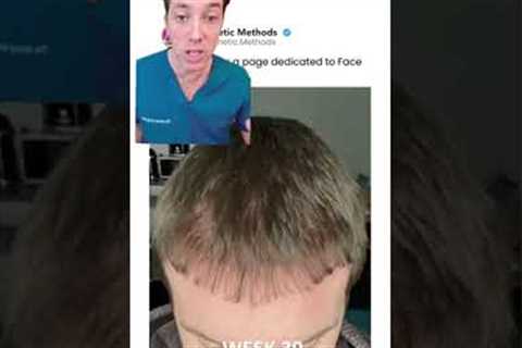 Hair Transplant Recovery Timeline