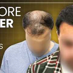 Hair Transplant Results, Cost, Month by Month Time Lapse, Best Hair Transplant in Agra, India