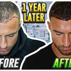 My Hair Transplant Results After 1 Year