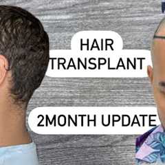 Hair Transplant 2 month Update
