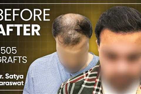 Hair Transplant Results, Cost, Month by Month Time Lapse, Best Hair Transplant in Agra, India