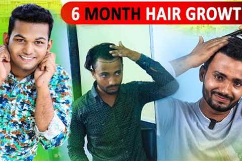 Hair Transplant 6 Month Results! Hair Growth in India 2025