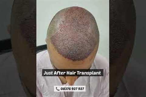 How does the hair look within 10 days of Hair Transplant|☎️08376927927 #prp #hairloss #baldness
