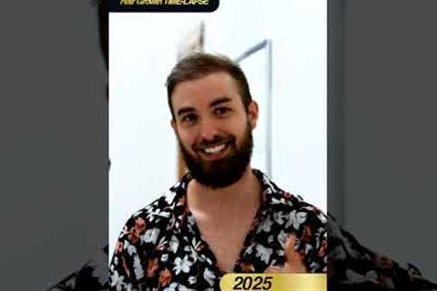 Mr.justin Hair growth time-LAPSE Incredible Result  after  2 years !#greffedecheveux   #hairextrem