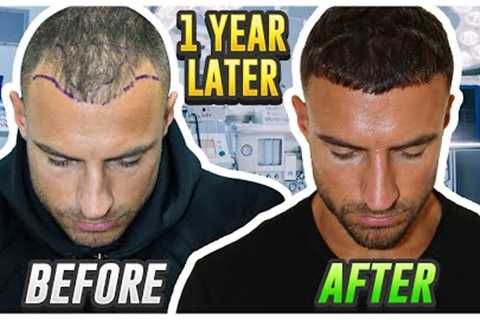 My Hair Transplant Results After 1 Year