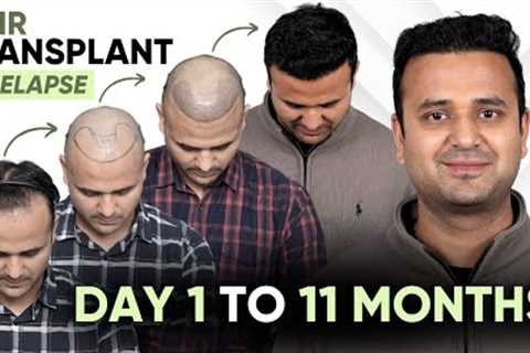 Hair Transplant Day 1 to 11 Months Result | Hair Transplant Timelapse | QHT Clinic | Hair Transplant