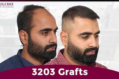 Natural Hairline &amp; Density: 1-Year Hair Transplant Results