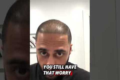 GOING BALD AFTER HAIR TRANSPLANT