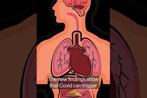 Long Covid Study Links Lingering Virus With Bowel-to-Brain Havoc