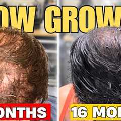 Slow Hair Transplant Growth? WATCH THIS!