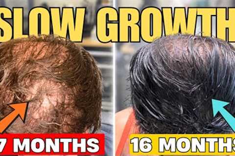 Slow Hair Transplant Growth? WATCH THIS!