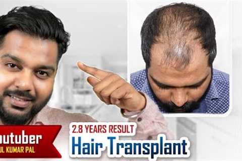 Youtuber Rahul Pal Hair Transplant Journey | Fantastic Hair Transplant Results #hairtransplant