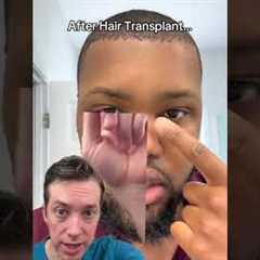 Black Hair Transplants: Why Your Hairline Matters