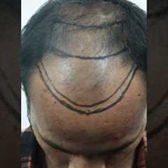 Hair Transplant Results [Before After] #hairtransplantinindia #viralvideo #shorts #hairtransplant