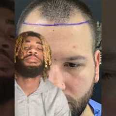 AMAZING Hair Transplant Growth #shorts