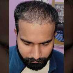 Amazing Hair Transplant Results | Latest Fue Technique #shorts #viral #hair transplant