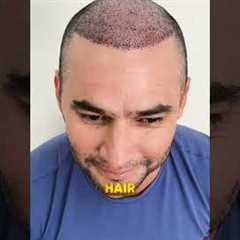 Five Months Hair Transplant Results | Latest Fue Technique #shorts #viral #hair transplant