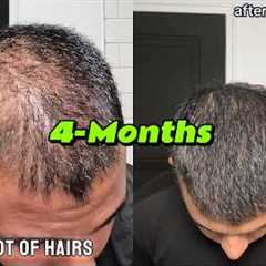 How I Reversed Hair Loss | 4 Months |  LifeOfNiravPatel