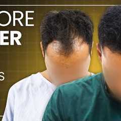 Hair Transplant Results, Cost, Before and After Time Lapse | Hair Transplant in Turkey vs India