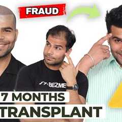 Hair Transplant in Mumbai | Best Results & Cost of Hair Transplant in Mumbai
