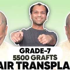 Hair Transplant in Mysore  | Best Results & Cost of Hair Transplant in Mysore